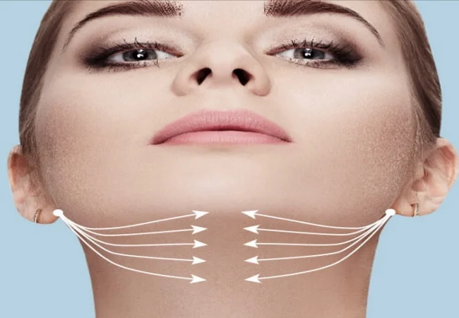 Chin augmentation