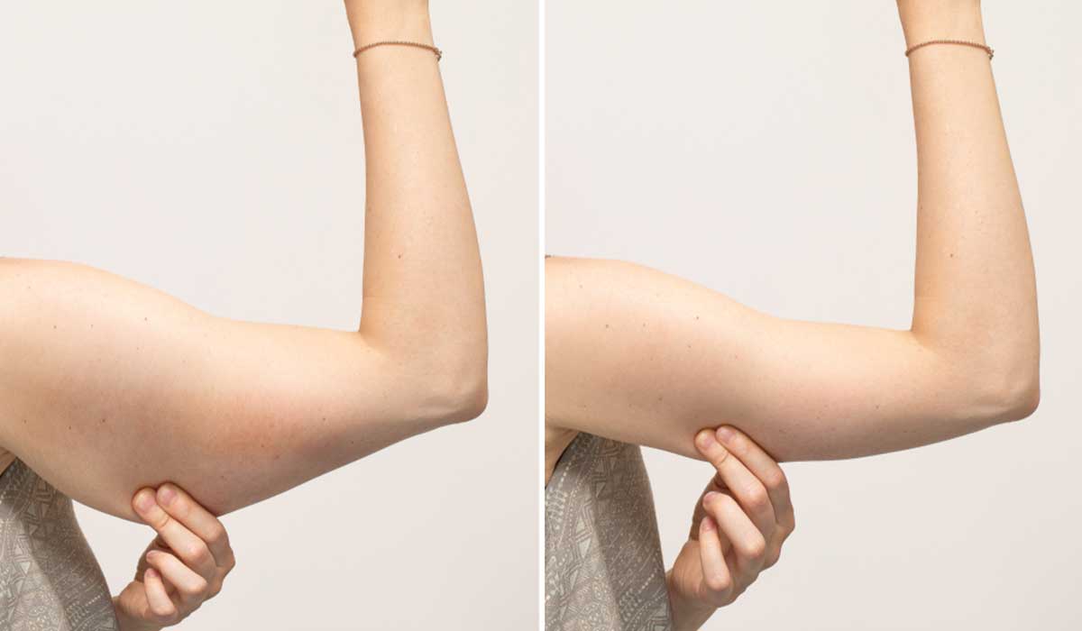 Arm lift and liposuction